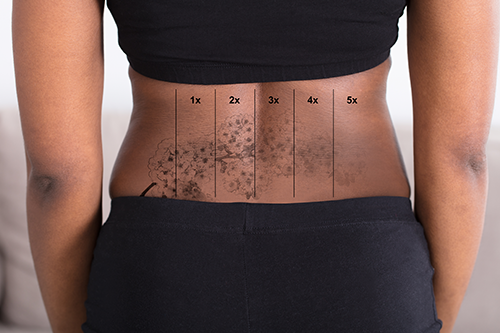 Tattoo remvoval client showing various stages of her tattoo removal from 1x to 4x with ink fading in each segment on her stomach